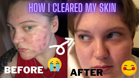 How I Cleared My Skin With My Acne Journey The Products