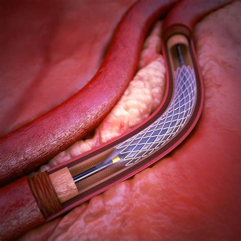 استنت گذاری اضافی شریان قلب باعث کاهش حملات قلبی در آینده می‌شود دکتر