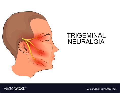 Trigeminal Neuralgia Neuroscience Royalty Free Vector Image