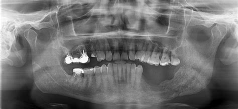 Mandibular Osteomyelitis Following Implant Placement Journal Of Oral