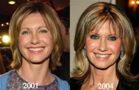 Olivia Newton John Plastic Surgery Before And After Photos