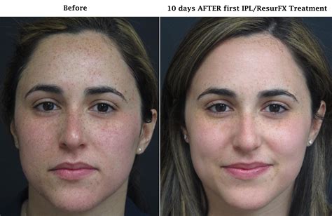 Before And After Iplresurfx Central Florida Dermatology Associates
