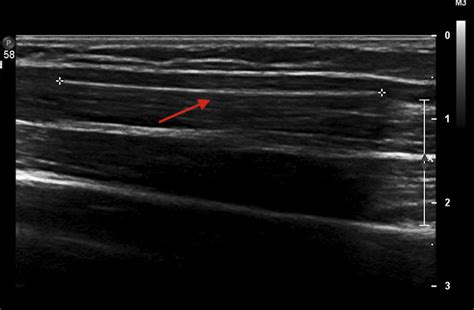 Contraceptive Implant Removals With The Use Of Ir Journal Of Vascular