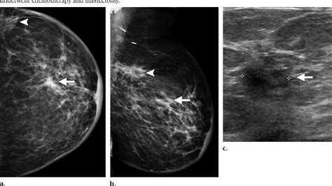 what radiologists need to know about diagnosis and treatment of inflammatory breast cancer a