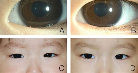 Epicanthal Folds Vs Normal Eye News Word