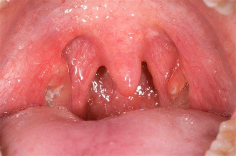 Bacterial Tonsillitis Photograph By Dr P Marazzi Science Photo Library