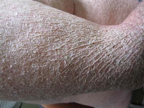 What Is Acquired Ichthyosis