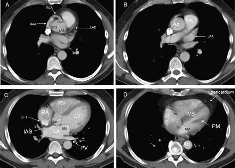 Cardiac Findings On Non Gated Chest Computed Tomography A Clinical And