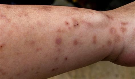 What Do Bed Bug Bites Look Like On Adults And Children