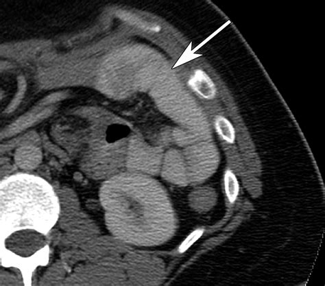 Internal Hernia After Gastric Bypass Sensitivity And Specificity Of