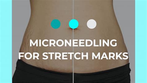 Microneedling For Acne Scars Works Dermaroller Sa® Blog