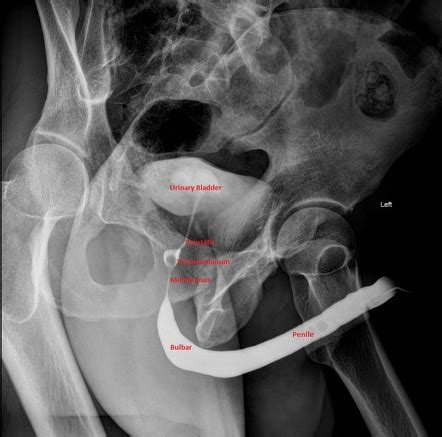Normal Retrograde Urethrogram Annotated Radiology Case