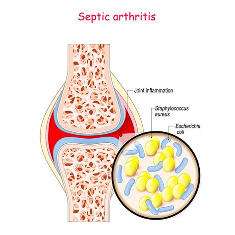 Septic Arthritis Vejthani Hospital