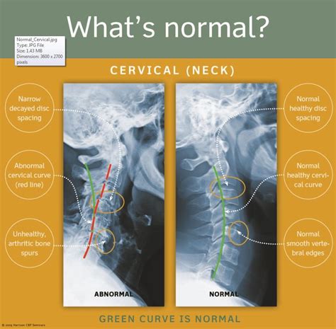 1 Normalcervical Chiropractic Cervical Health Chart