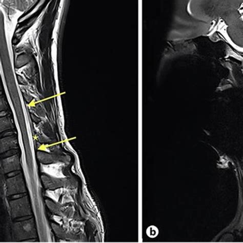 Mri Cervical Spine With Axial T2 Weighted Gradient Echo Images In A