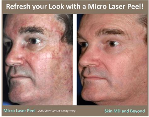 Micro Laser Peel In Plano Tx Skin Md And Beyond