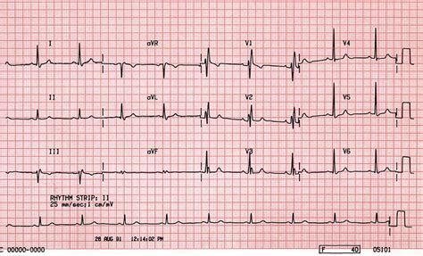 B23 Right Bundle Branch Block Rbbb Ecgs At St Emlyns