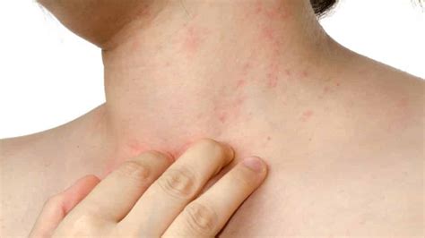 Dermatite Atopica Cos Come Riconoscerla E Come Curarla Efficacemente
