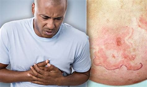 Heart Attack Symptoms Signs Of Heart Disease Include Rash On Your Skin