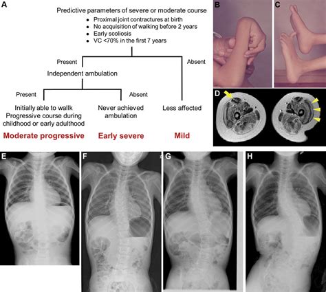 Ullrich Congenital Muscular Dystrophy Clinicopathological Features