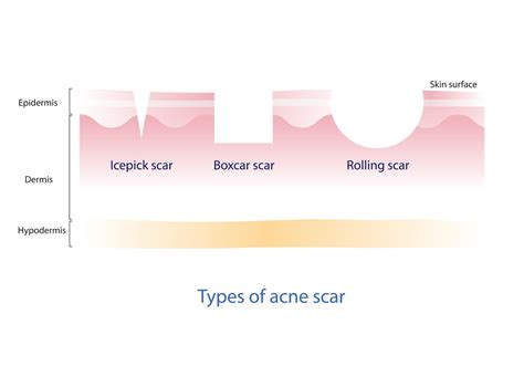 Acne Scars Types And How To Treat Them