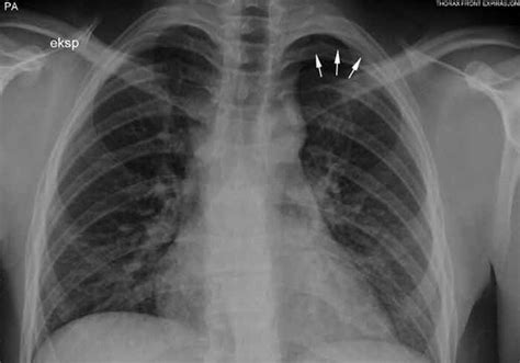 A Young Man With Chest Pain Tidsskrift For Den Norske Legeforening