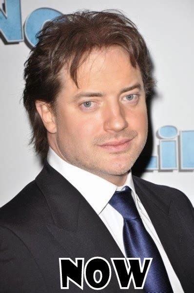 Brendan Fraser Plastic Surgery Hair Transplant Before And After Star