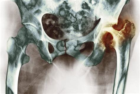 Osteoarthritis Of The Hip Joint X Ray Stock Image C