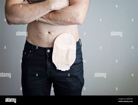 Colostomy Bag Hi Res Stock Photography And Images Alamy