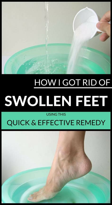 How I Got Rid Of Swollen Feet Using This Quick And Natural Remedy In