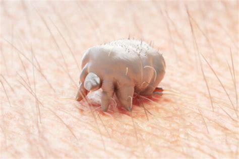 Causes Symptoms And Treatments For Scabies Step To Health