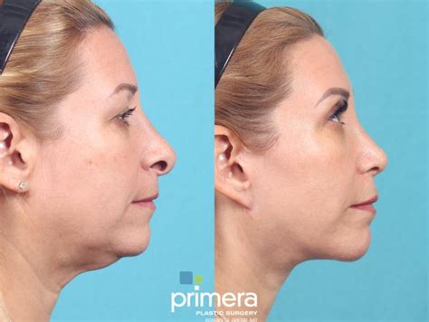 Mini Facelift Before And After Pictures Case 700 Orlando Florida Primera Plastic Surgery