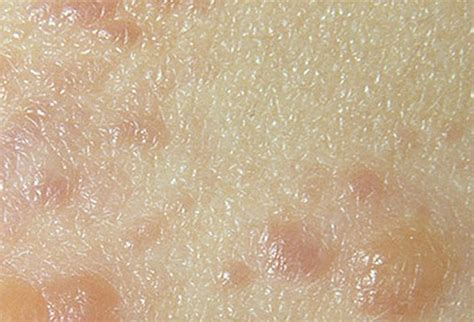 Dermatitis Herpetiformis Photos Symptoms Causes Treatment