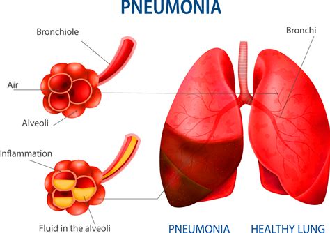 Human Lungs Pneumonia Lunges Infographic Clip Art Illustration