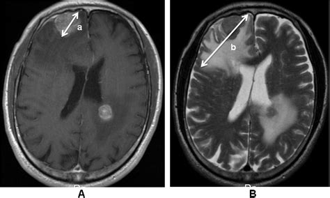Metastatic Brain Tumors From Non Small Cell Lung Cancer With Egfr