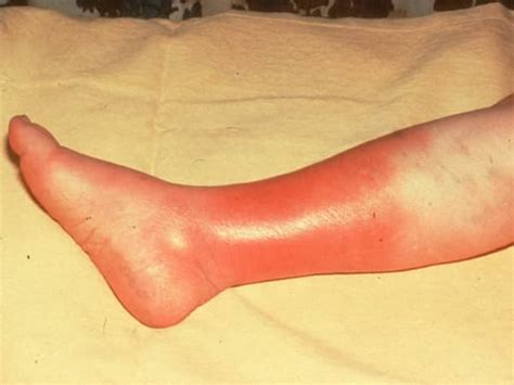 Cellulitis Pictures Symptoms Treatment Contagious Causes Types