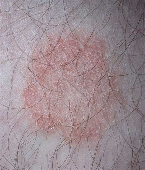 Bjj Skin Infections How To Prevent And Treat Them