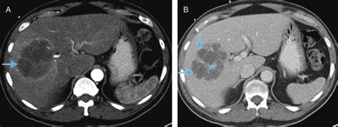 Dynamic Contrast Enhanced Computed Tomography Ct A Late Arterial