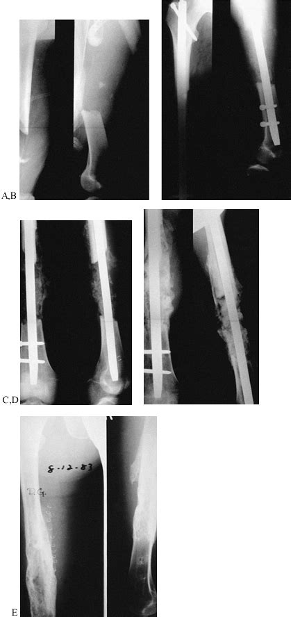 Diaphyseal Fractures Of The Femur Teachme Orthopedics