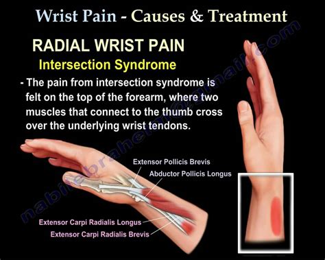 Wrist Paincauses And Treatmentpart 2 Everything You Need To Know