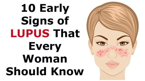 Early Signs Of Lupus Symptoms Symptoms Of Disease
