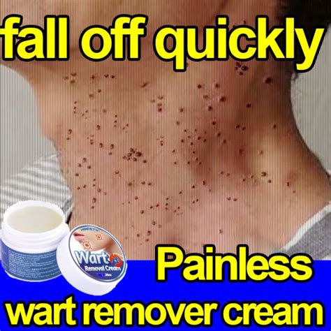 wart removal cream fast remove skin tag remover original ointment against condyloma acuminata