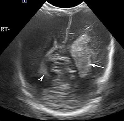 Grade 3 Ivh On Left Head Us Coronal Image In A 3 Day Old Neonate Born