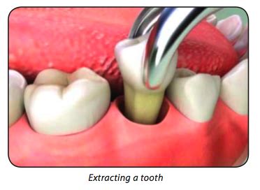 See more ideas about tooth extraction healing, tooth extraction, tooth extraction aftercare. Tooth Extraction - fss-dental