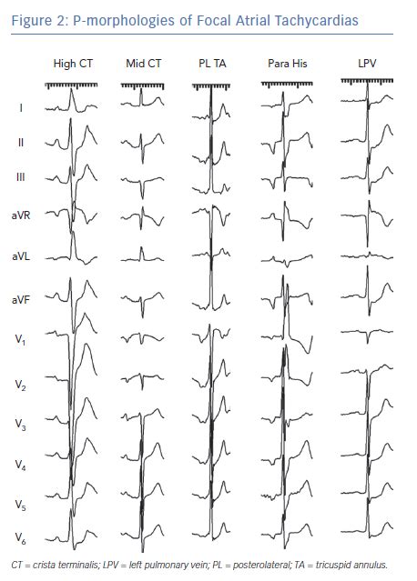 P Morphologies Of Focal Atrial Tachycardias Radcliffe Cardiology