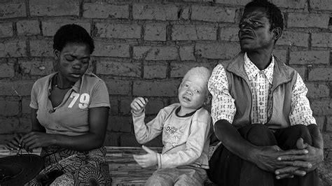 What Is Albinism And What Causes It African Newspage Reporting