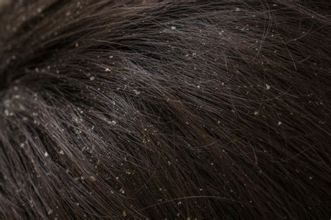 Dandruff Vs Dry Scalp Mystery 11 Effective Ways To Solve Conquering Flaky Scalp Health And Beauty