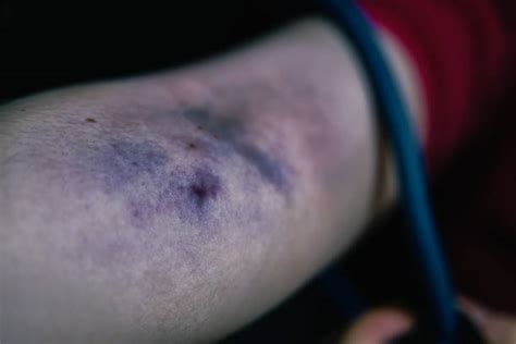 Iv Bruise Stock Photos Pictures And Royalty Free Images Istock