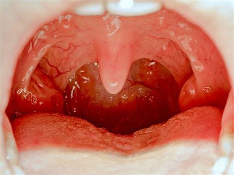 Tonsil Infection Signs Of A Tonsil Infection