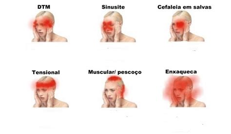 sinais de que as dores de cabeça são perigosas e deves procurar um médico urgentemente